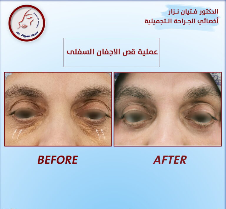 قص الاجفان السفلى 768x708