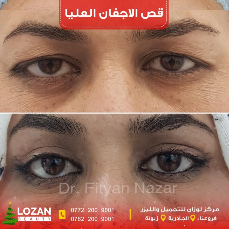 قص الاجفان العليا 768x768