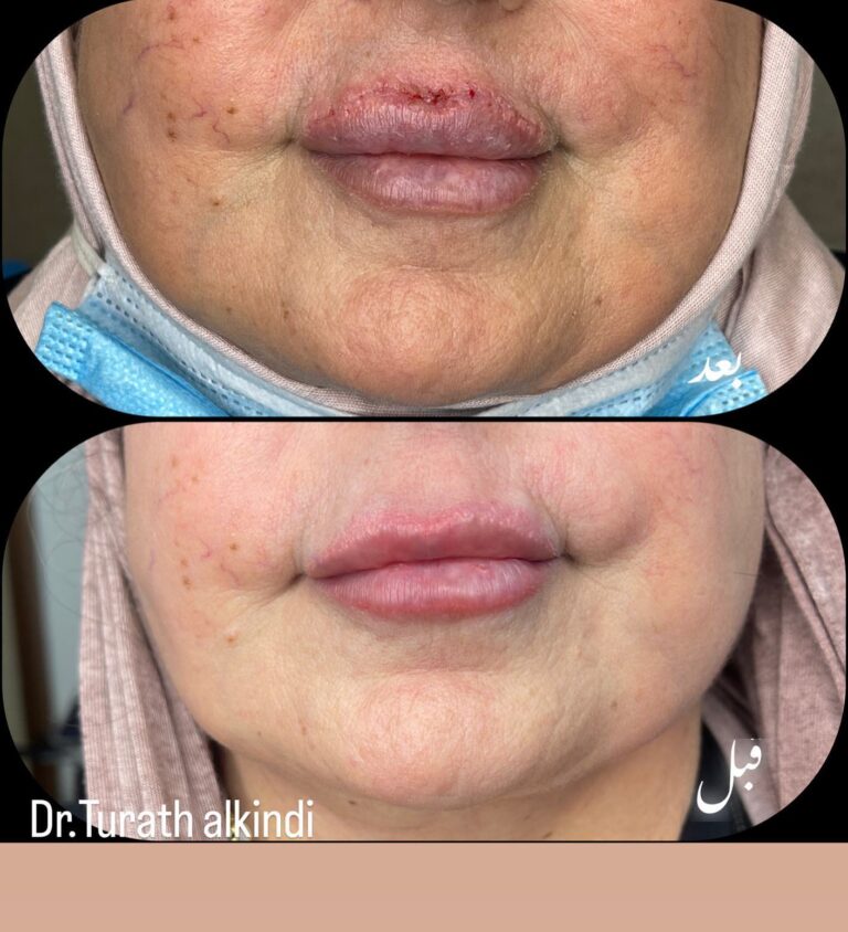 قلب الشفه جراحيا 768x844