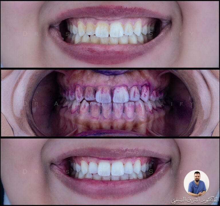 مراحل تبييض الاسنان 768x720