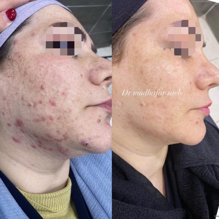 معالجه الحب واثاره 768x768