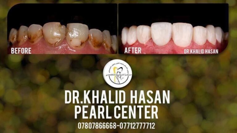 معالجه تصبغ الاسنان 768x432