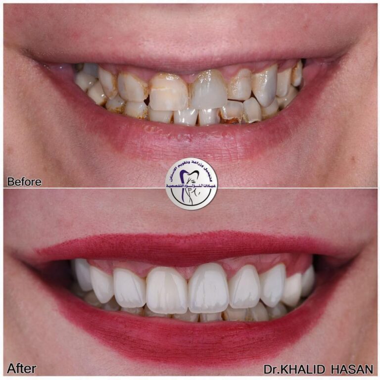 معالجه وتجميل الحشوات 768x768