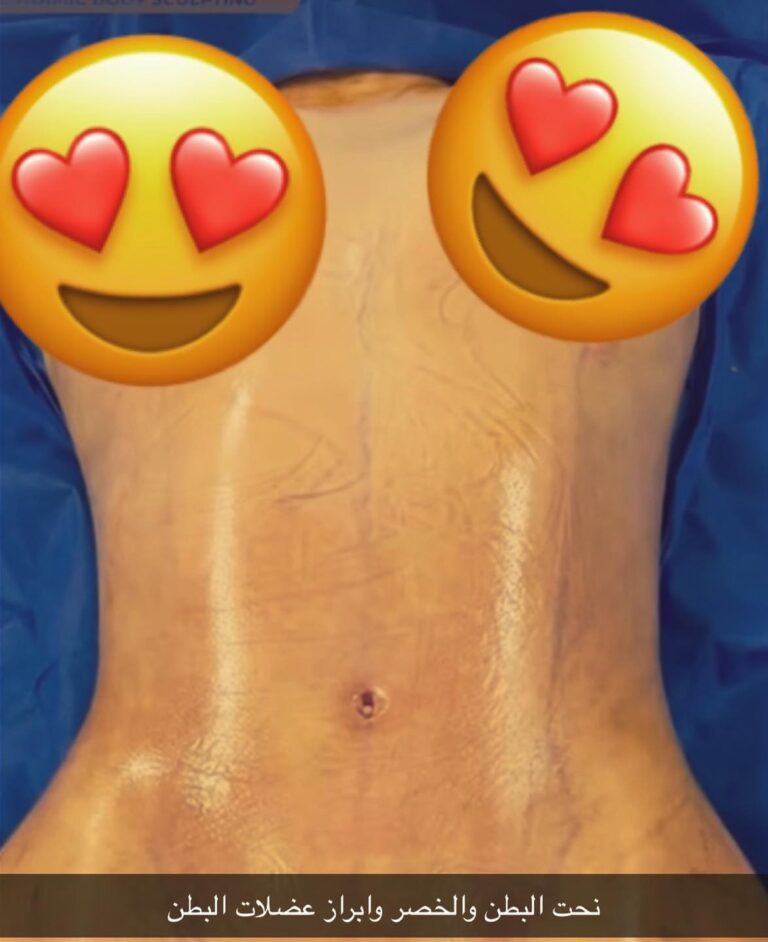 نحت البطن والخصر 768x942