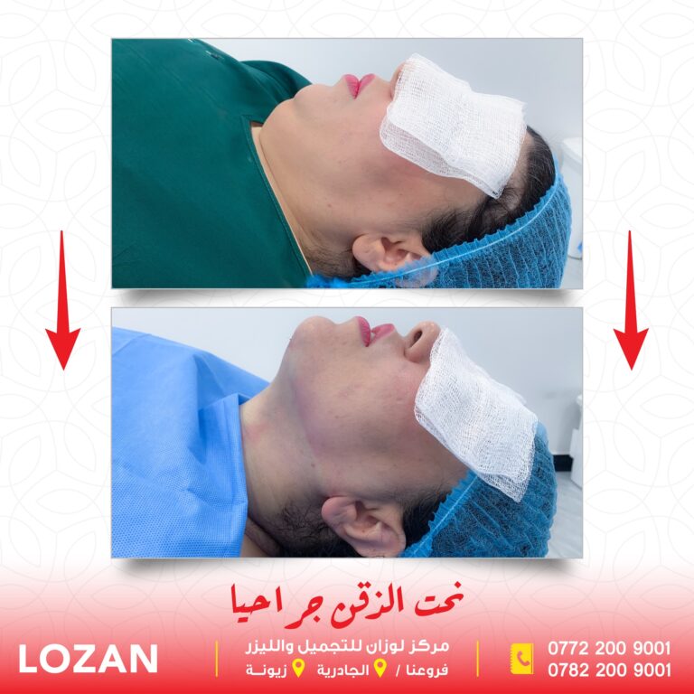 نحت الذقن 768x768