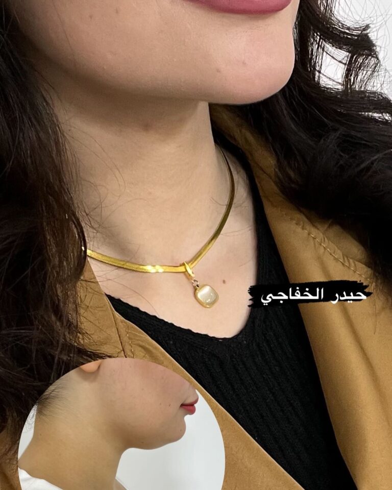 نحت شفط الذقن 768x960