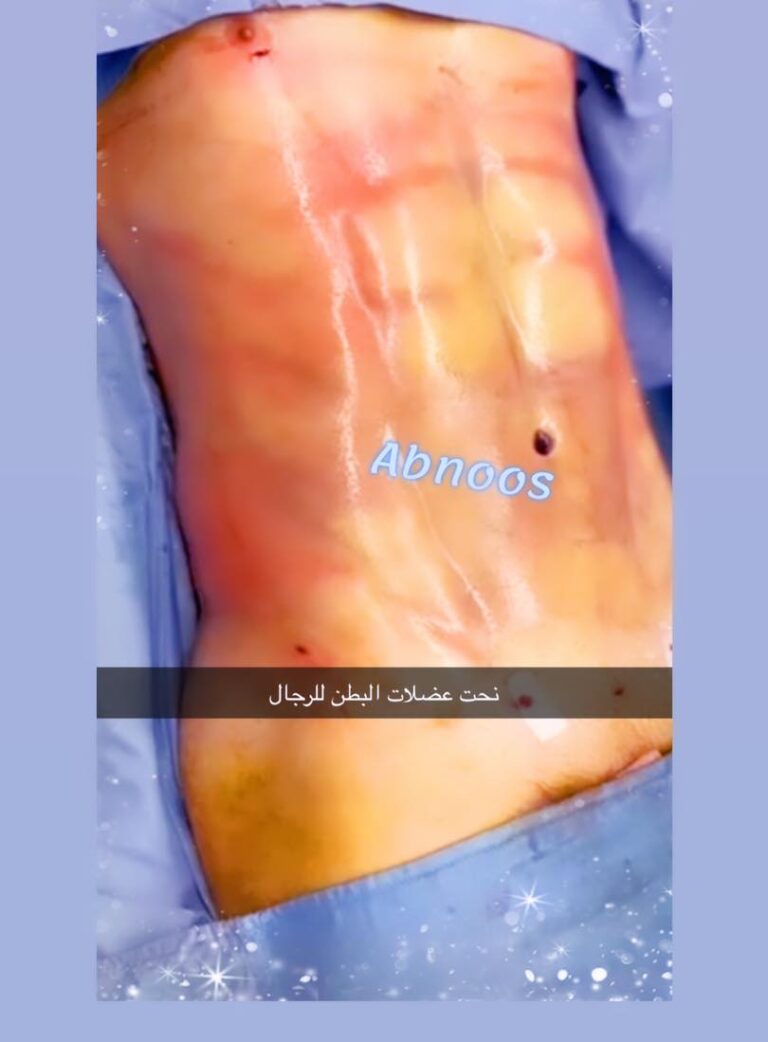 نحت عضلات البطن 768x1042