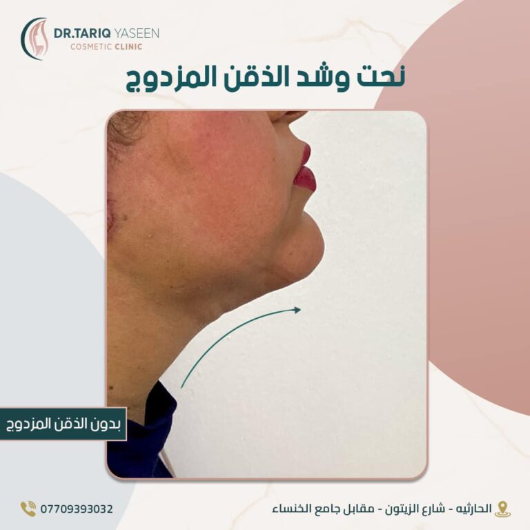 نحت وشد الذقن 768x768