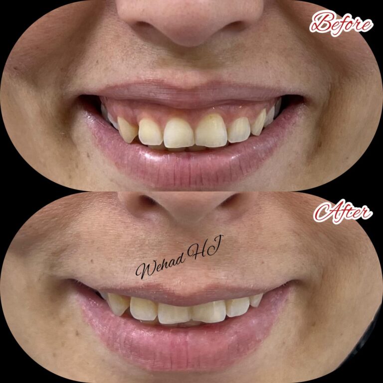 ابتسامه لثويه 768x768