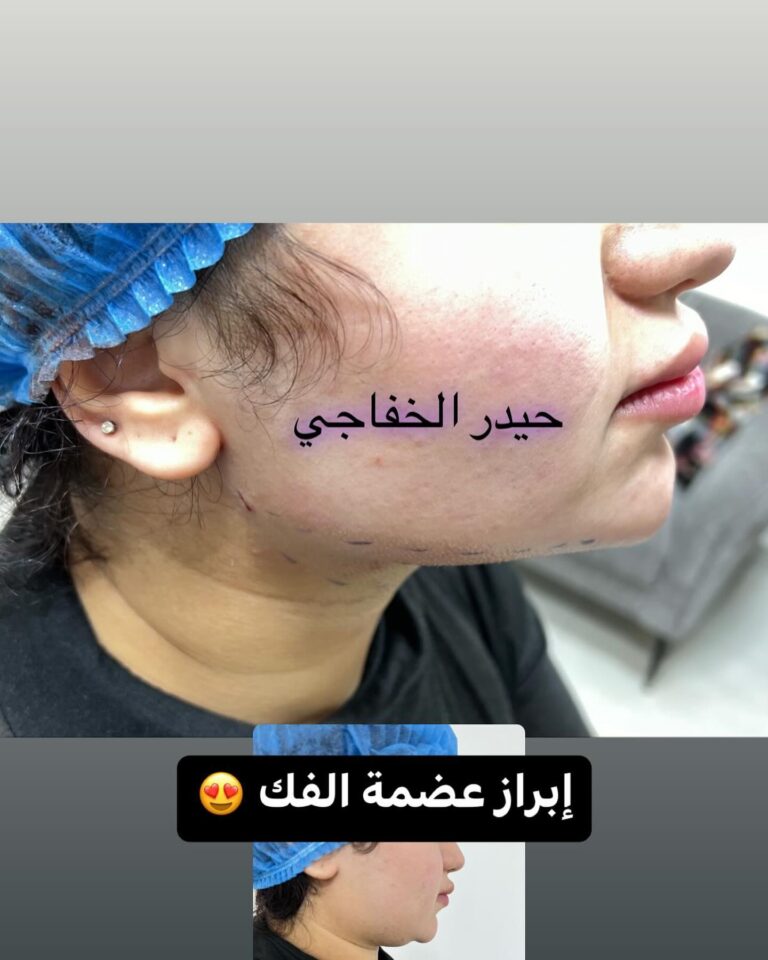 ابراز عضمه الفك 768x960