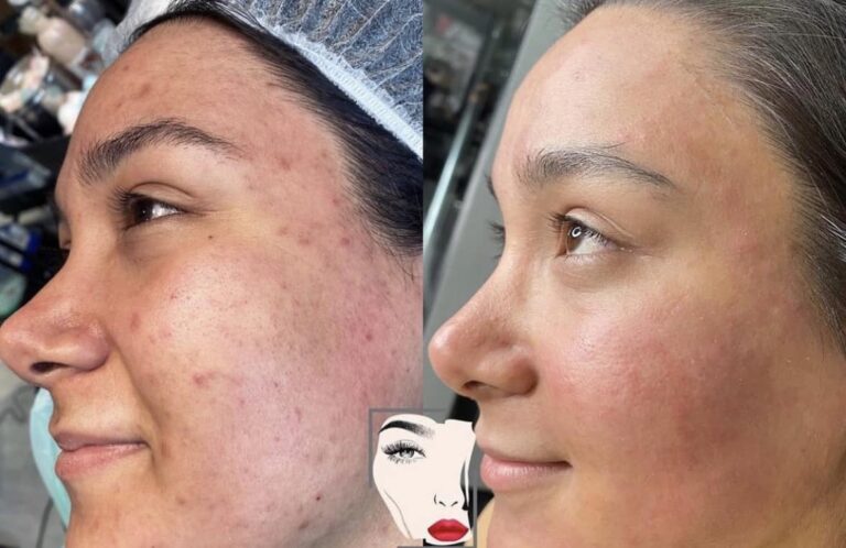 اثار الحبوب ازالة 768x498