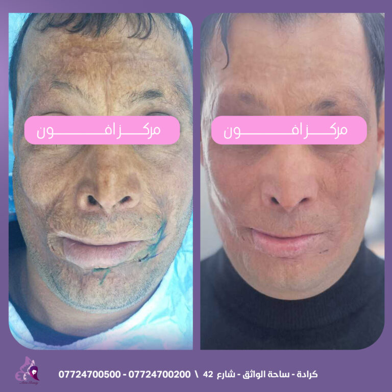 اثار الحريق 768x768