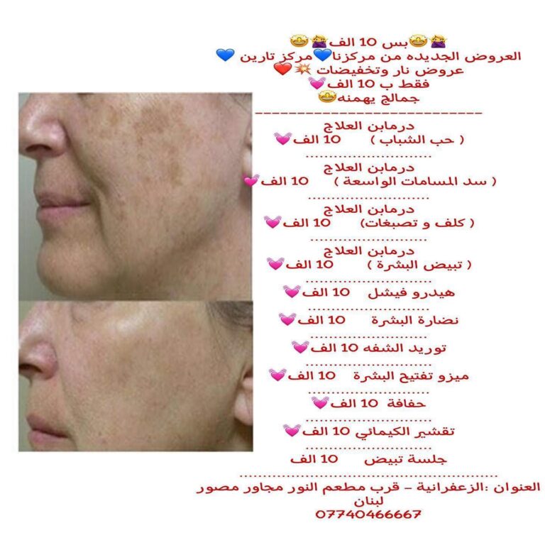 اثار حب الشباب 1 1 768x768