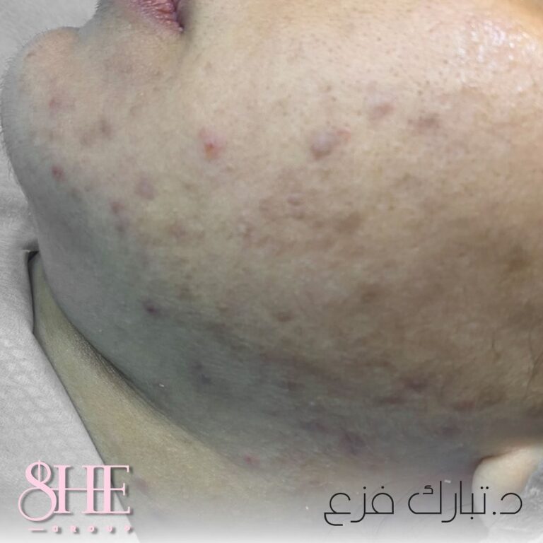 اثار حب الشباب 1 768x768