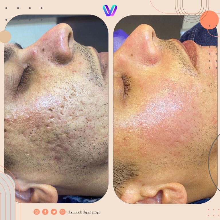 اثار حب الشباب 768x768