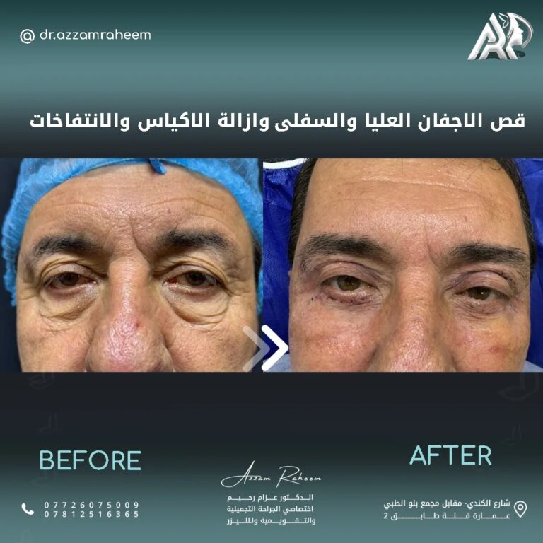ازالة الاكياس 768x768