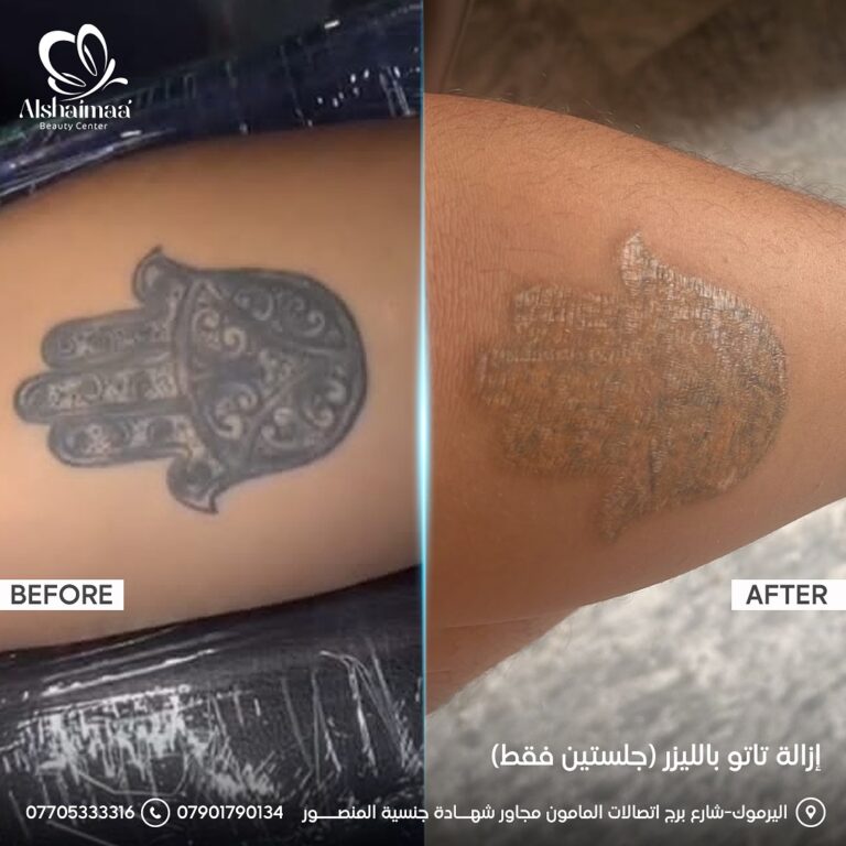 ازالة التاتو 768x768