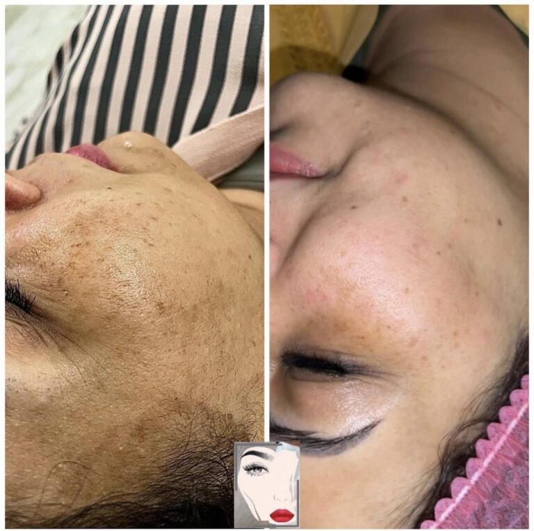 ازالة التصبغات 768x763