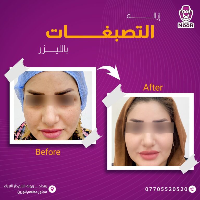 ازالة التصبغات باليزر 768x768