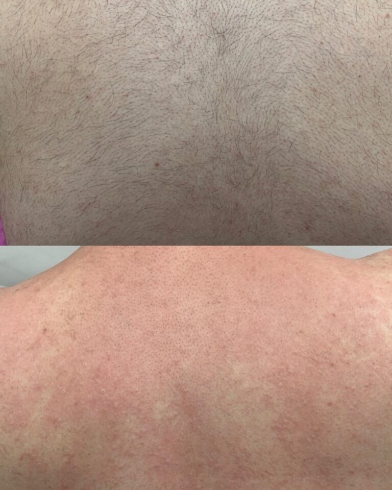 ازالة الشعر 1 768x960