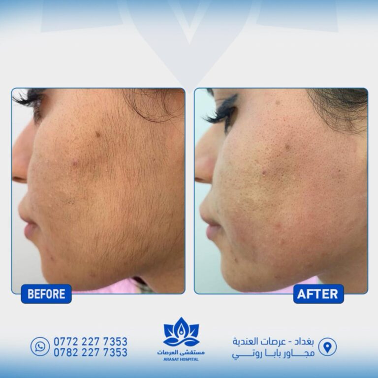 ازالة الشعر 3 768x768