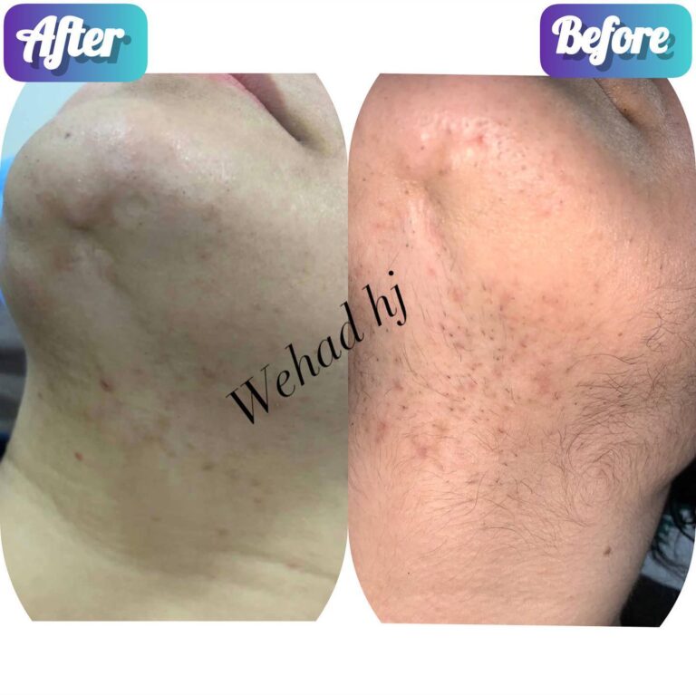 ازالة الشعر 768x767