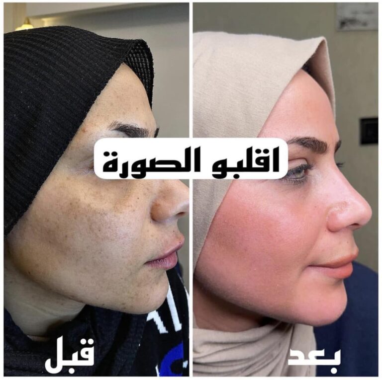 ازالة الكلف 1 768x765