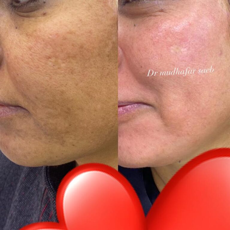 ازالة الكلف 768x768