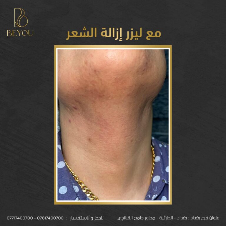 ازالة شعر 768x768