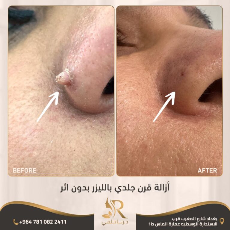 ازالة قرن جلدي 768x768