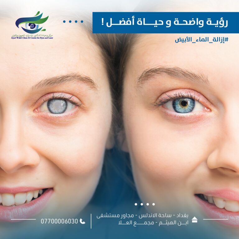 ازالة ماء العين الابيض 768x768