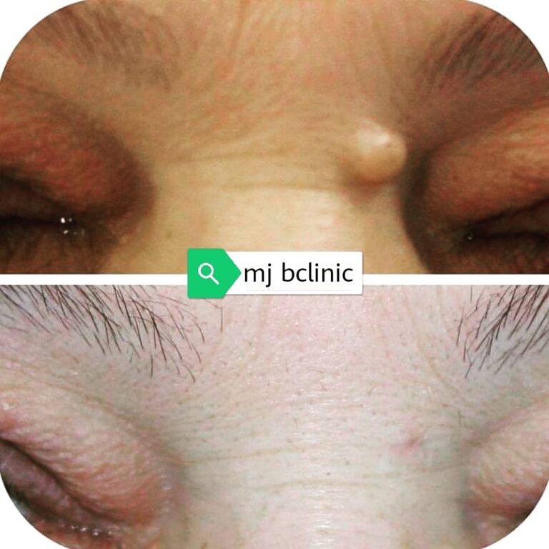 ازاله الاكياس الدهنيه 768x768