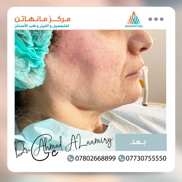 ازاله التجاعيد 768x768