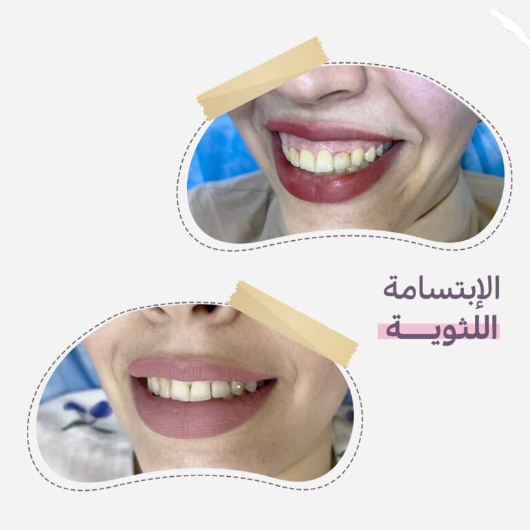 الابتسامه اللثويه 768x768