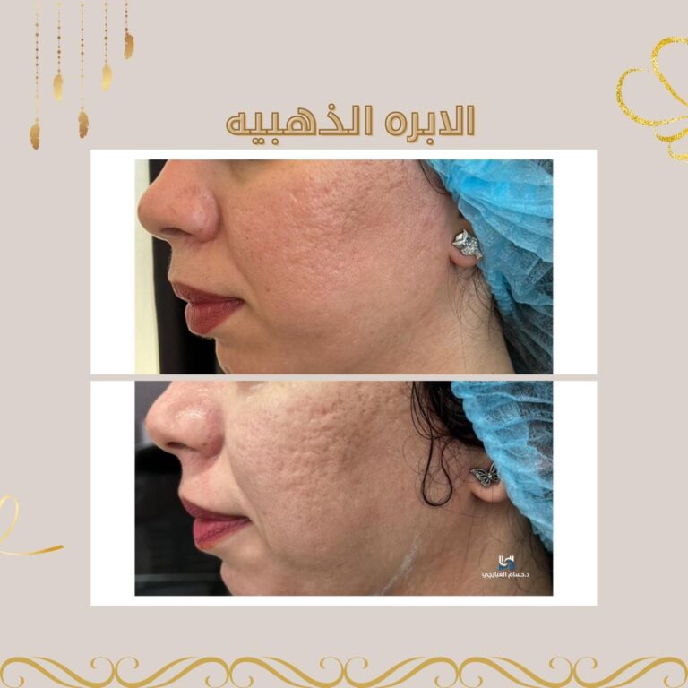 الابره الذهبيه 768x768