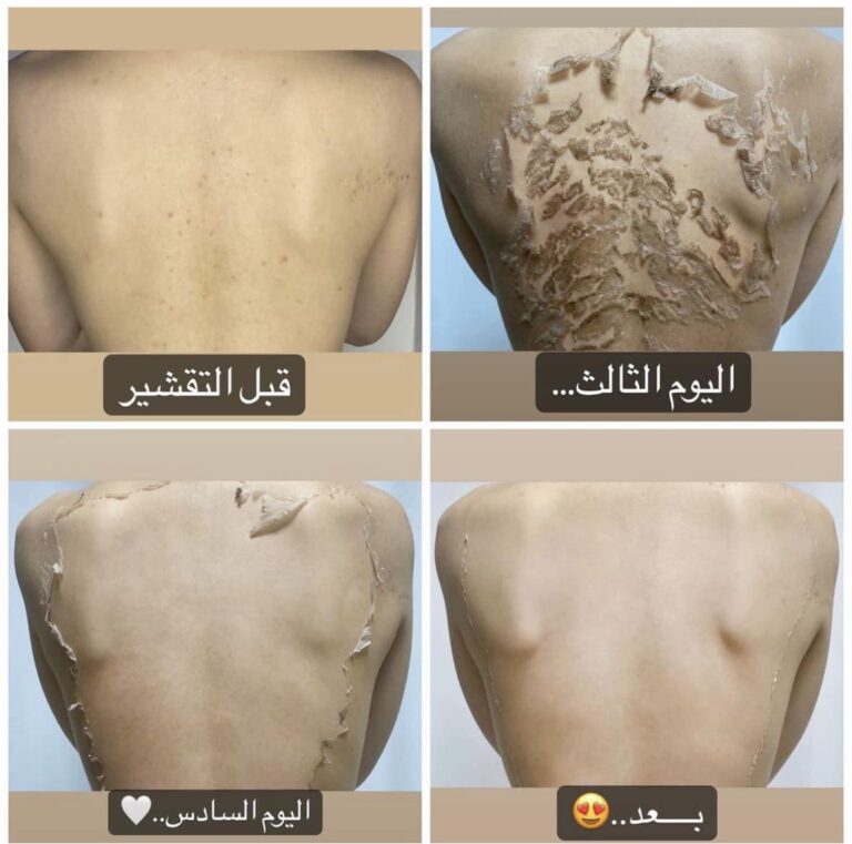 التقشير الظهري 768x761