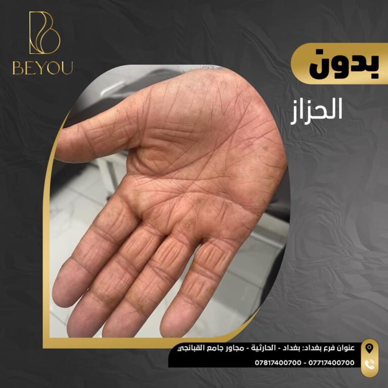 الحزاز 768x768