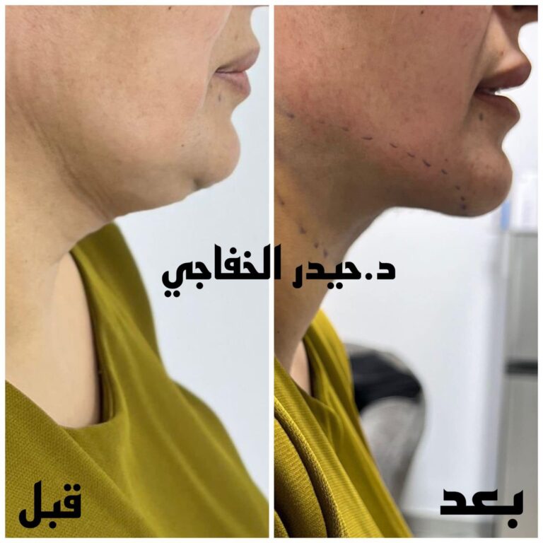 الذقن المزدوج 768x768