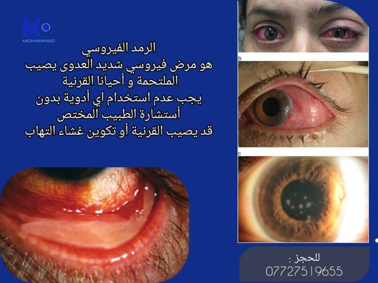 الرمد الفيروسي 768x576