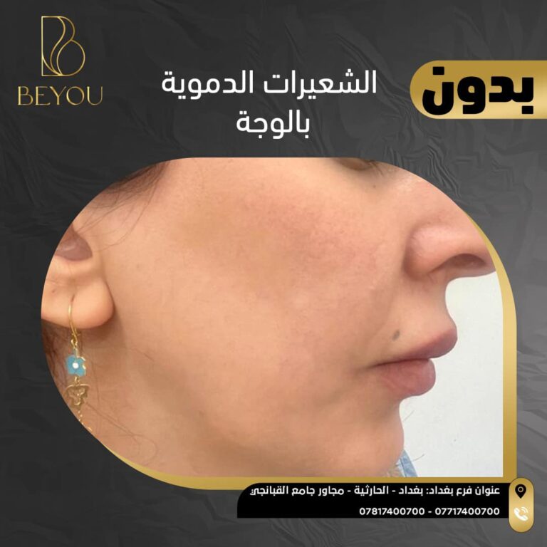 الشعيرات الدمويه للوجه 768x768