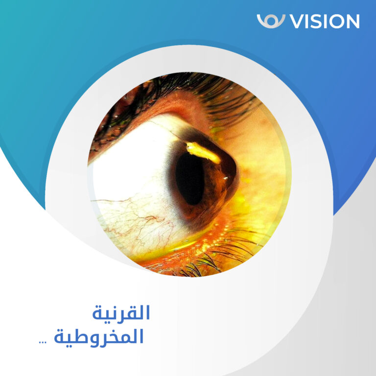 القرنيه المخروطيه 3 768x768