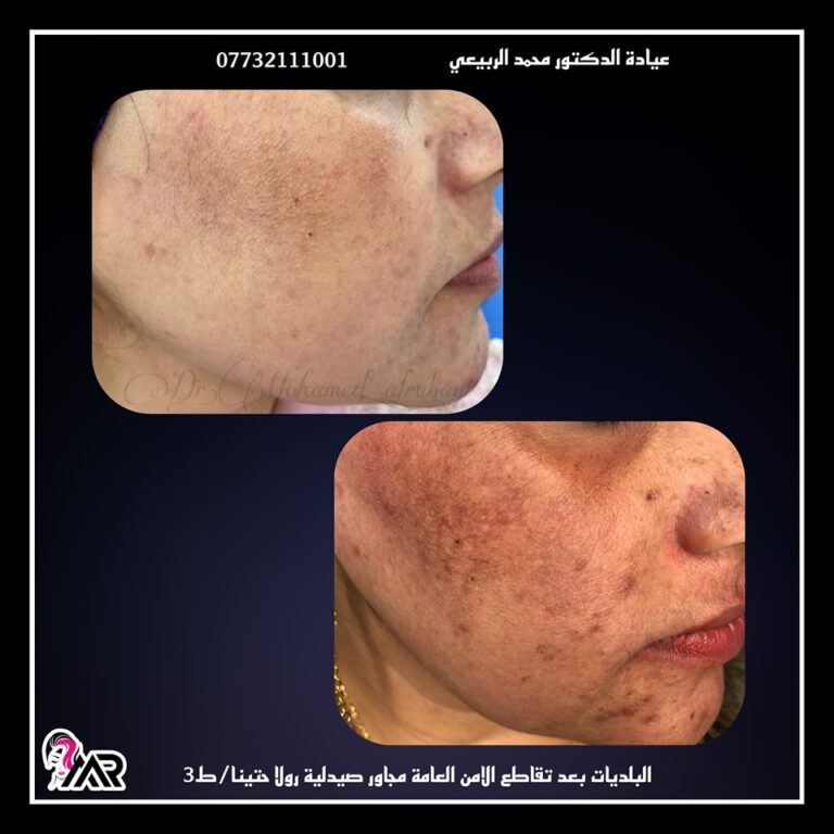 الكلف العميق 768x768