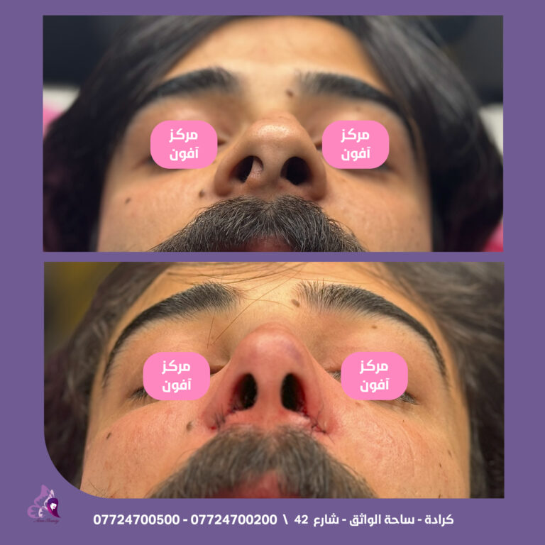 انحراف الانف 768x768