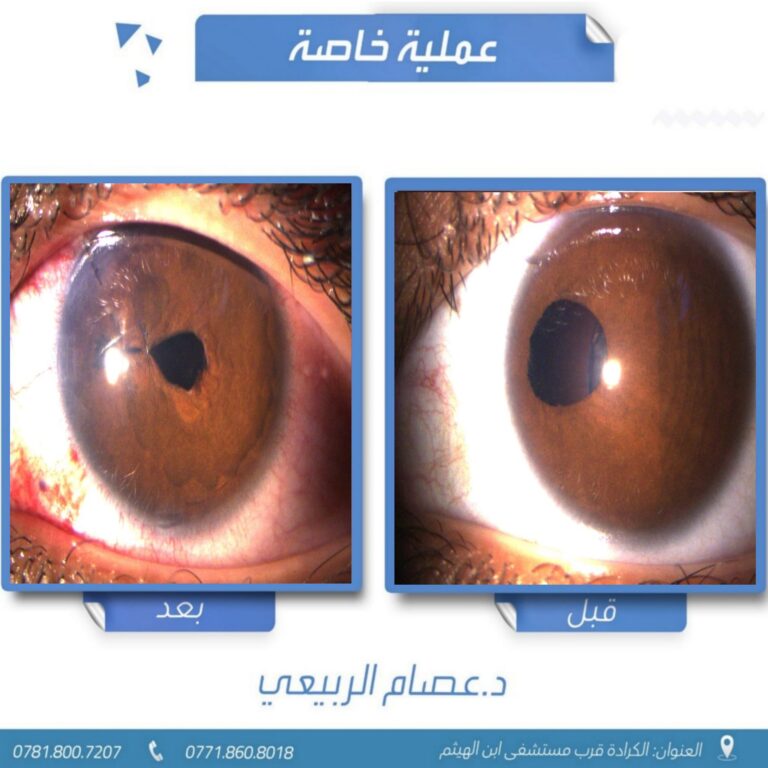 انحراف بؤبؤ العين 768x768