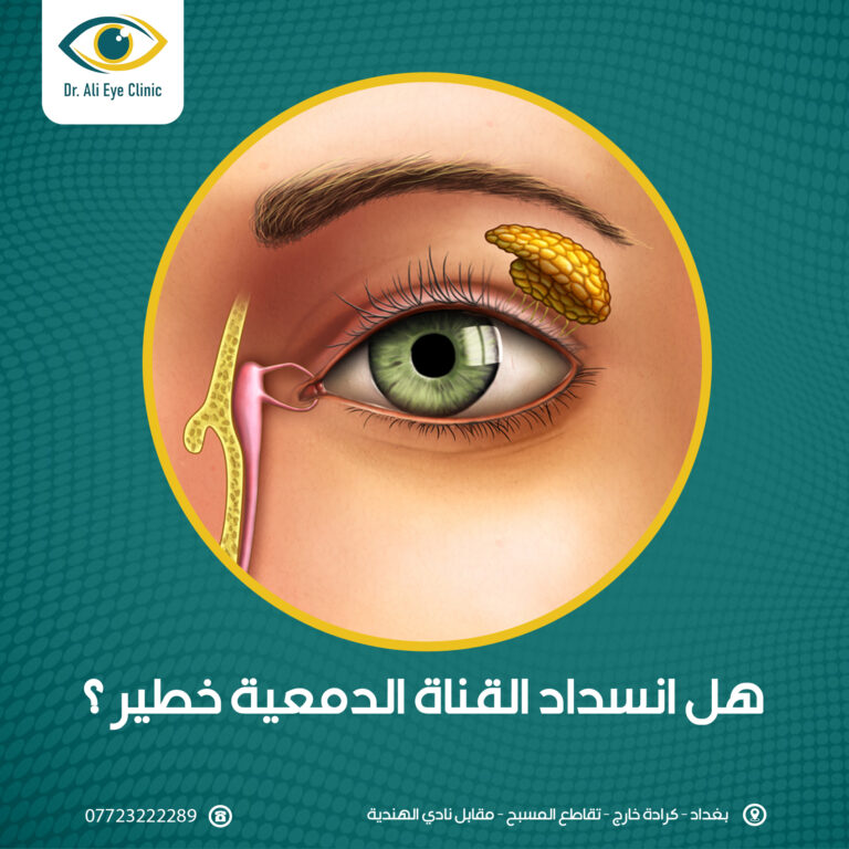 انسداد القناة الدمعيه 768x768