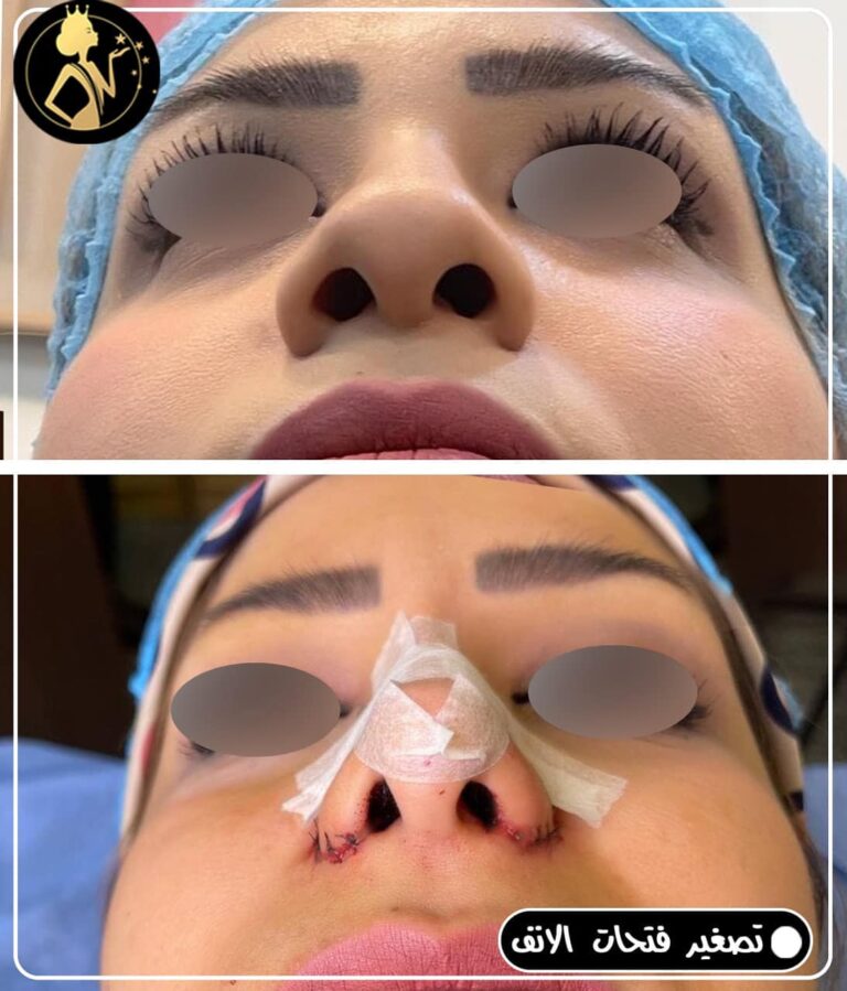 انف 768x899