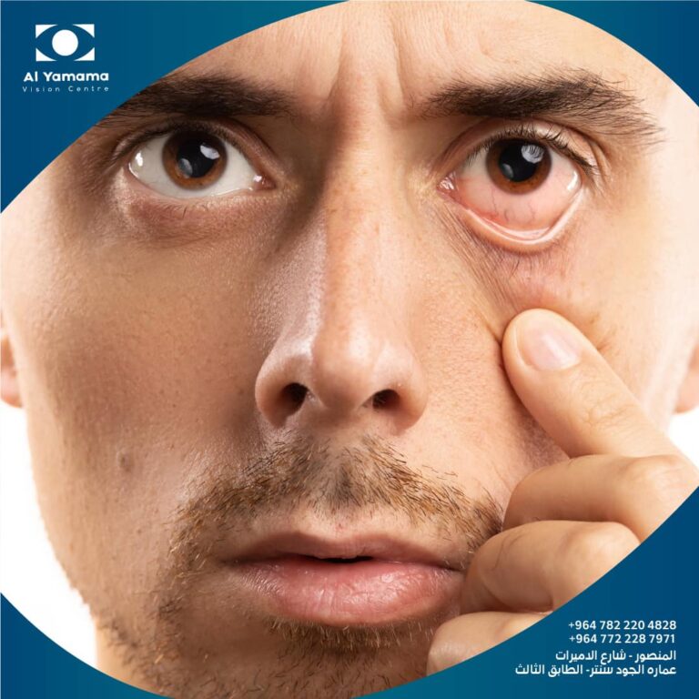 انفصال الشبكيه 768x768