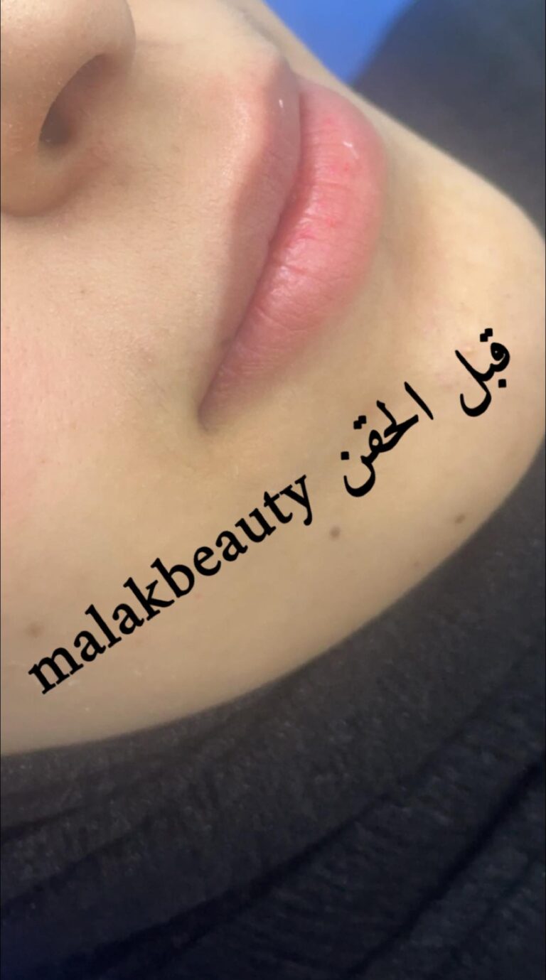 بعد الحقن 1 768x1379