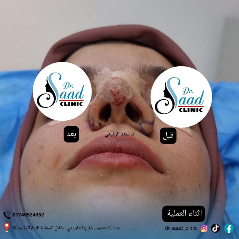 بعد العمليه 1 768x768