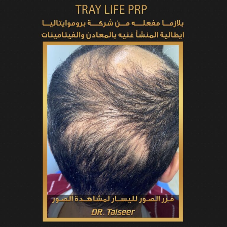 بلازما مفعله 768x768